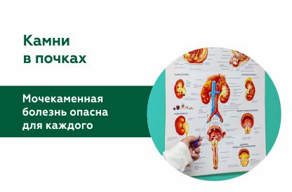 Лечение мочекаменной болезни