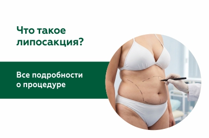 Иллюстрация к статье "Что такое липосакция?"